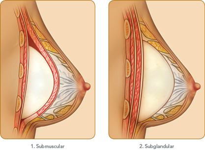 Facts about breast implants Ideal facts about breast implants late